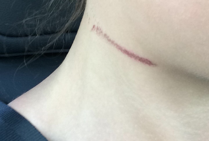The incident left Emma with a permanent scar
